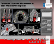 Планирование в Blue Sky Plan - соблюдении зоны безопастности до анатомических структур и других импл Москва